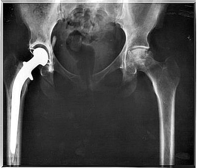 X-ray of a dysplasia